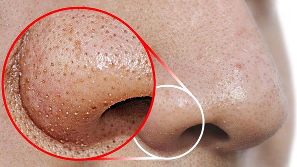 How to remove blackheads from the nose - Tips and tricks