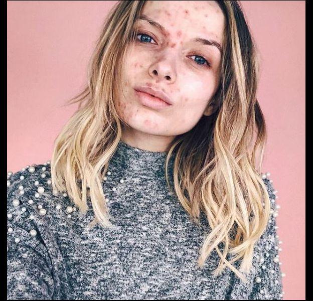 These badass influencers who bring down the acne complex