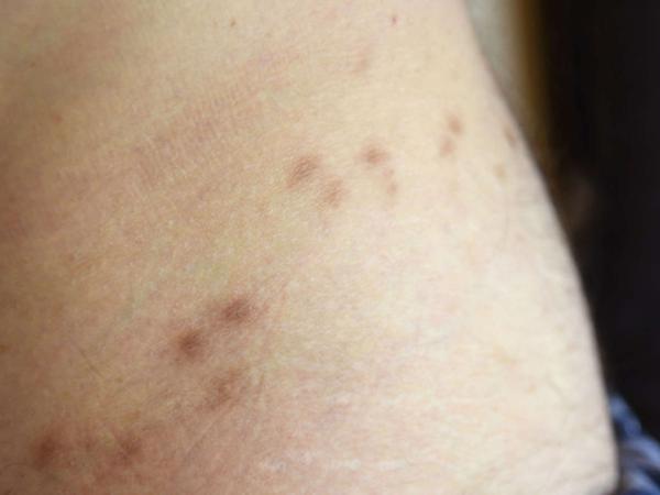 Krätze ist zurück: Ansteckung, Ursache, Behandlung und wie Sie die Hautkrankheit erkennen