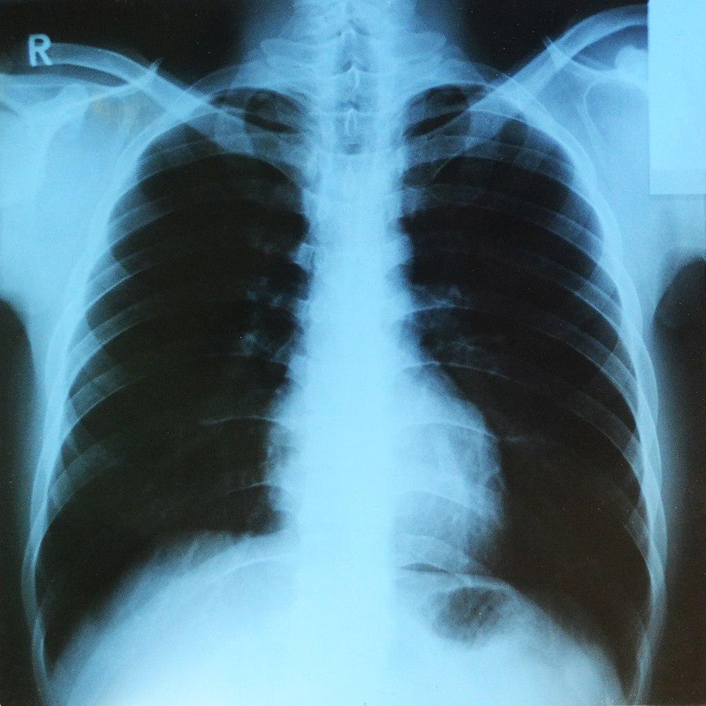 röntgenkuvaus