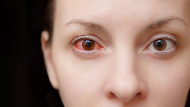 You're Treating Pink Eye the Wrong Way
