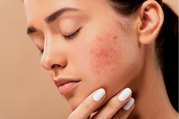 10 formas naturales de ayudar a despejar los poros obstruidos