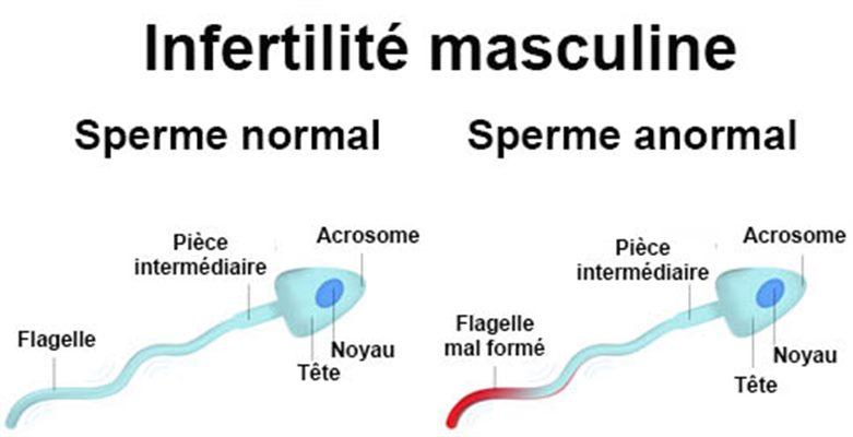 The causes of infertility in men