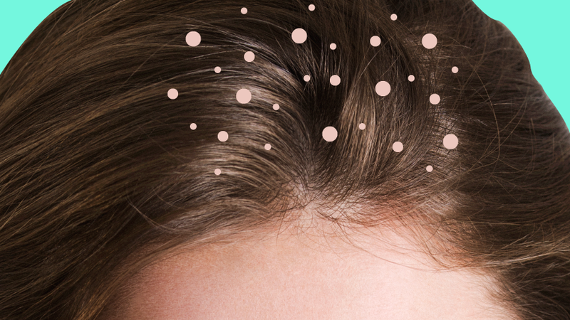 9 Things Everyone Gets Wrong About Dandruff