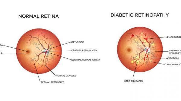 Diabeettinen retinopatia