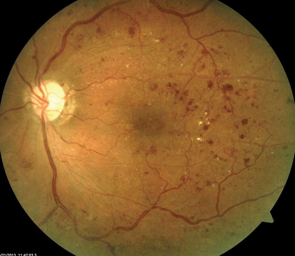 Diabetic retinopathy 