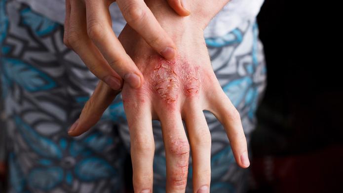 Persistent dermatitis