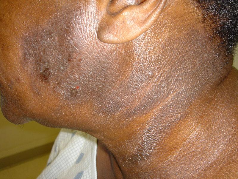 Persistent dermatitis 