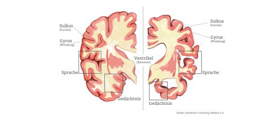 Enfermedad de Alzheimer: causas, síntomas, tratamientos 