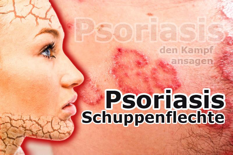 Psoriasis hat einen starken Einfluss auf das Sexualleben der Patienten 