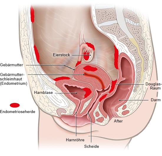 Endometriose: Wie kann man Schmerzen lindern?