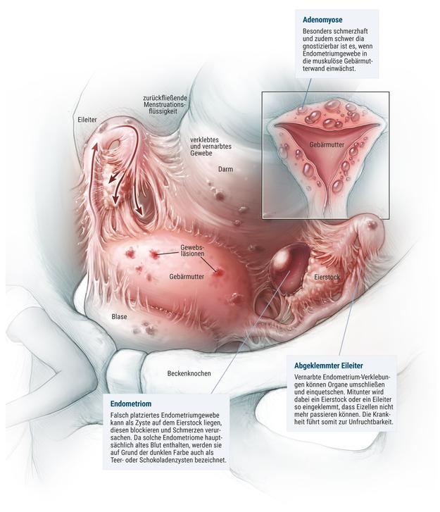 Endometriose: Wie kann man Schmerzen lindern? 