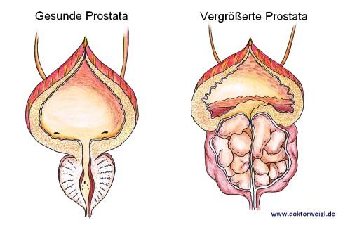 Vergrößerte Prostata: Medikamente können Herzinsuffizienz verursachen 