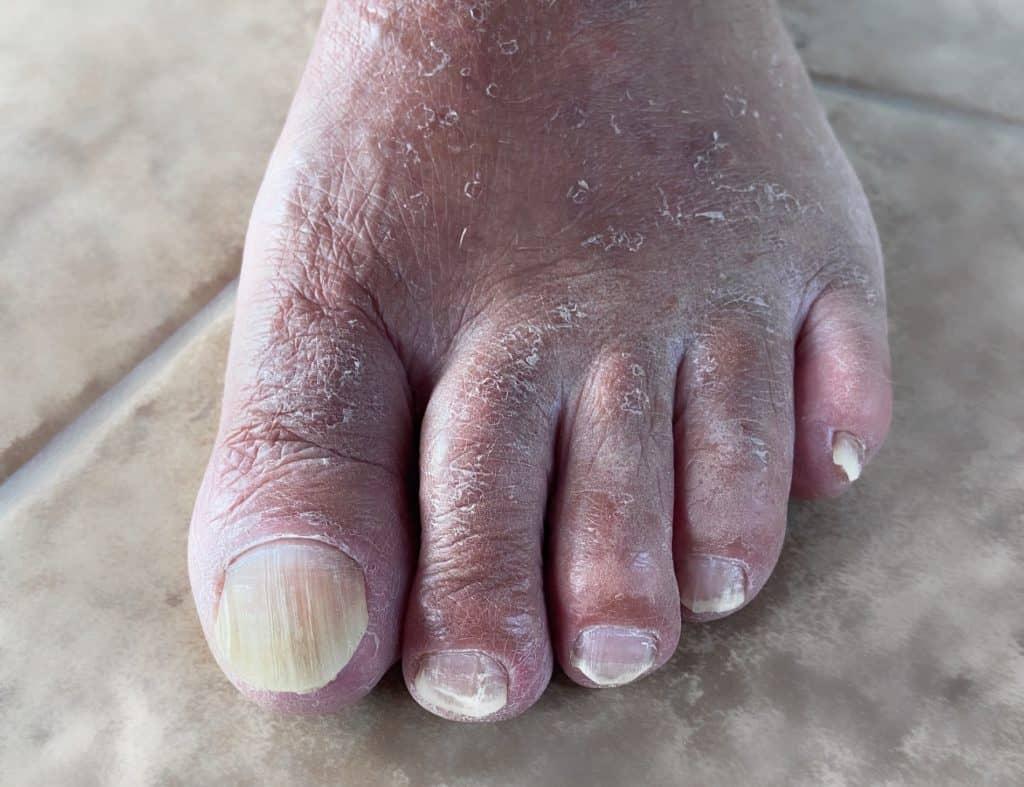 Wie man Fußpilz behandelt, laut Podologen und Dermatologen 