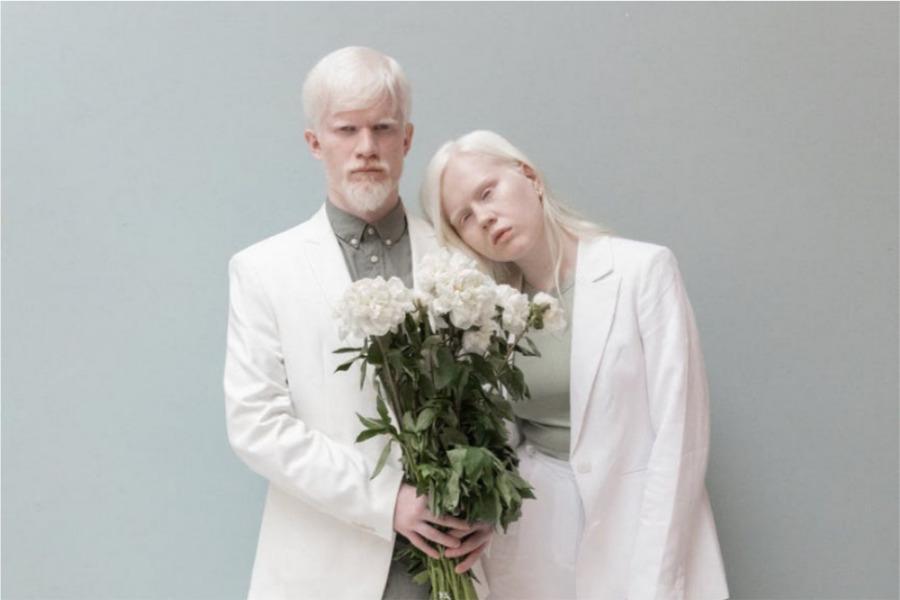 Estos son los problemas de salud que tienen los albinos por tener la piel tan blanca 