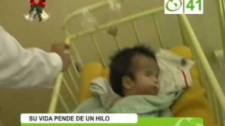 One month with hydrocephalus was abandoned at Hospital de Yarinacocha