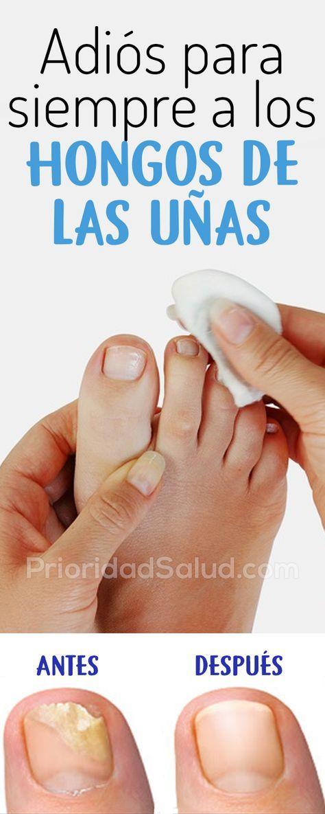 Cómo eliminar hongos en las uñas de los pies