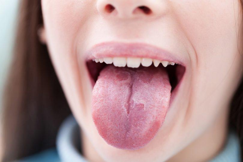 Bílý povlak na jazyku často souvisí se špatnou ústní hygienou. Příčiny ale mohou být i závažnější