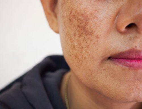 Vitiligo : « Je me cachais avec le fond de teint pour qu’on ne voit pas mes taches » 