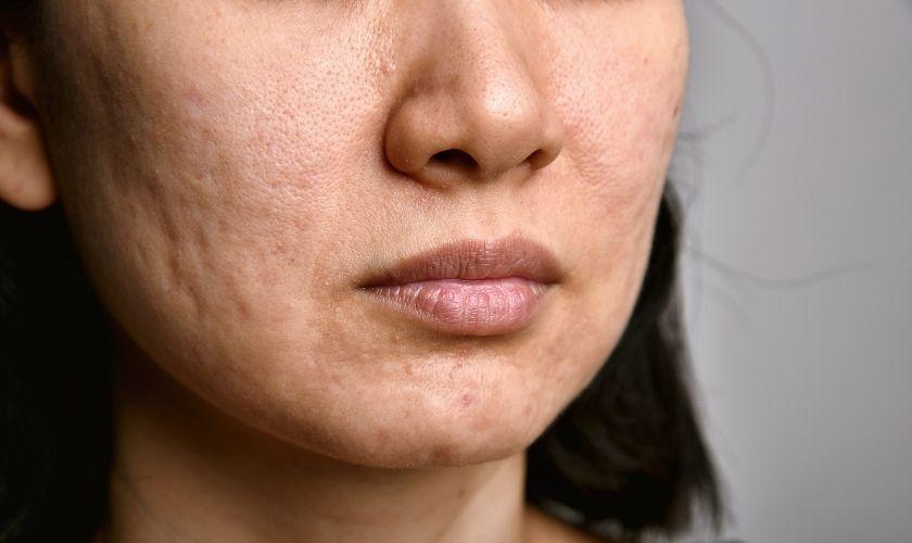 ACNE IN ADULTS
