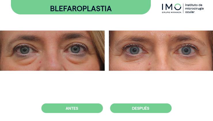 Blefaropastia: ¿por qué está en auge este tipo de cirugía ocular?