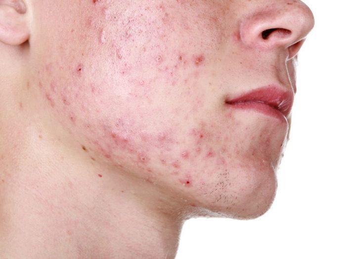 Belleza Remedios naturales para las cicatrices del acné en la piel
