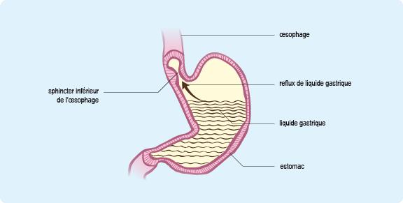 Simples régurgitations ou reflux gastro-oesophagien ?