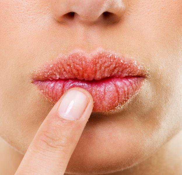 Lèvres gercées : causes, comment les soigner ? 