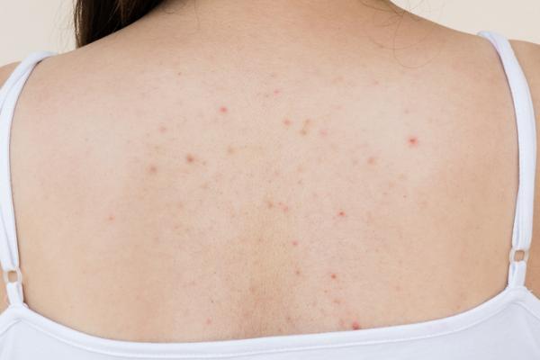 Home remedies to eliminate back acne