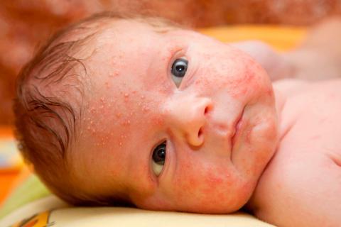 Sudamina, dermatitis and an allergic reaction, these are their differences