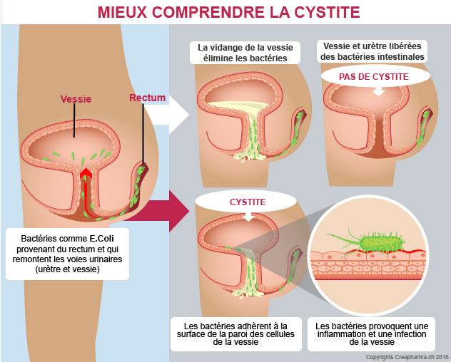 Cystite: definition, types, symptoms, what to do?