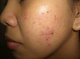 New treatments in acne