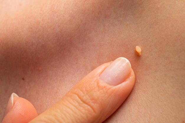 Get a common wart? Eliminate it with this simple trick 