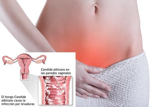 Cómo evitar y curar la candidiasis vaginal