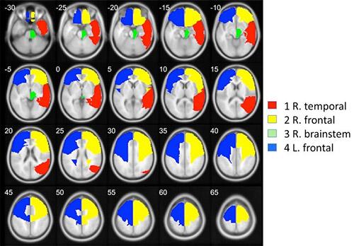 Meditation based on mental silence increases gray matter and helps maintain cognitive functions