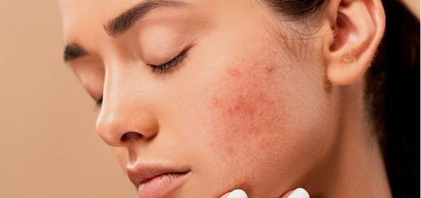 Cuatro pasos fundamentales para eliminar el acné provocado por la mascarilla 