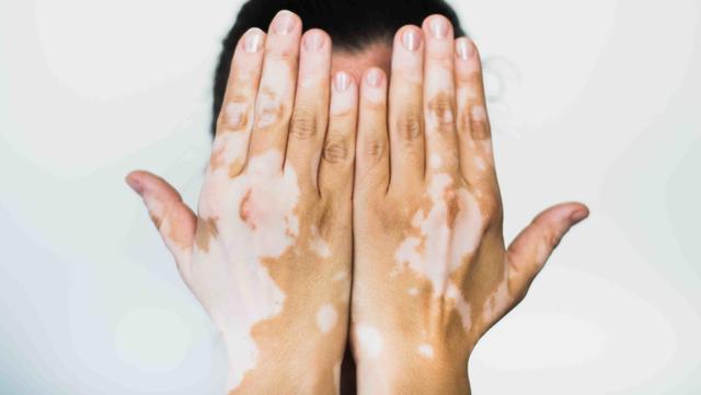 Vitiligo: How to treat skin depigmentation disease?