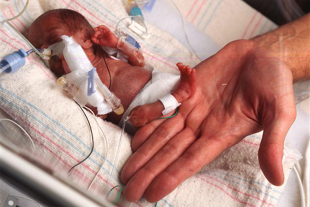 Un bebé nace a las 26 semanas y desafía a las probabilidades de supervivencia 