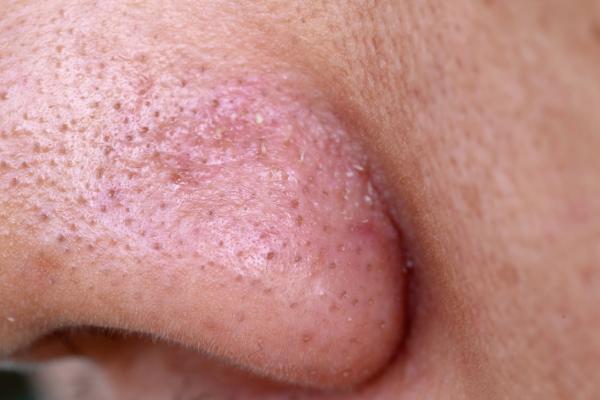 Tips to remove black spots from your nose