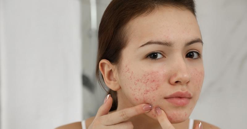 Adult acne: identify it for better treating it 