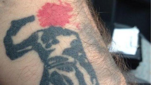 "Je détestais ça dès qu'il était terminé": Bad Body Art et regrette dans une clinique d'élimination de tatouage