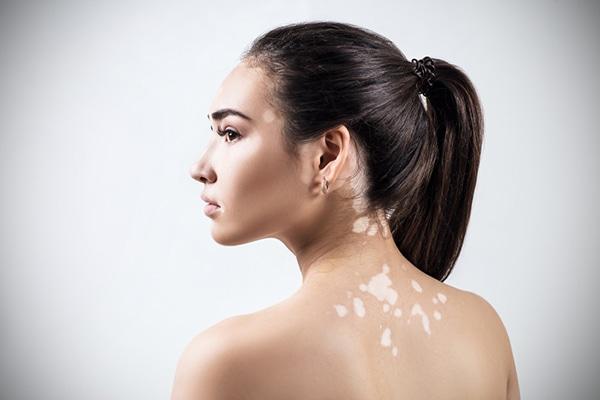 Vitiligo, todo sobre la enfermedad de las manchas blancas 