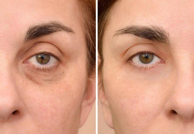 Guide to eliminate dark circles under the eyes and end a tired face