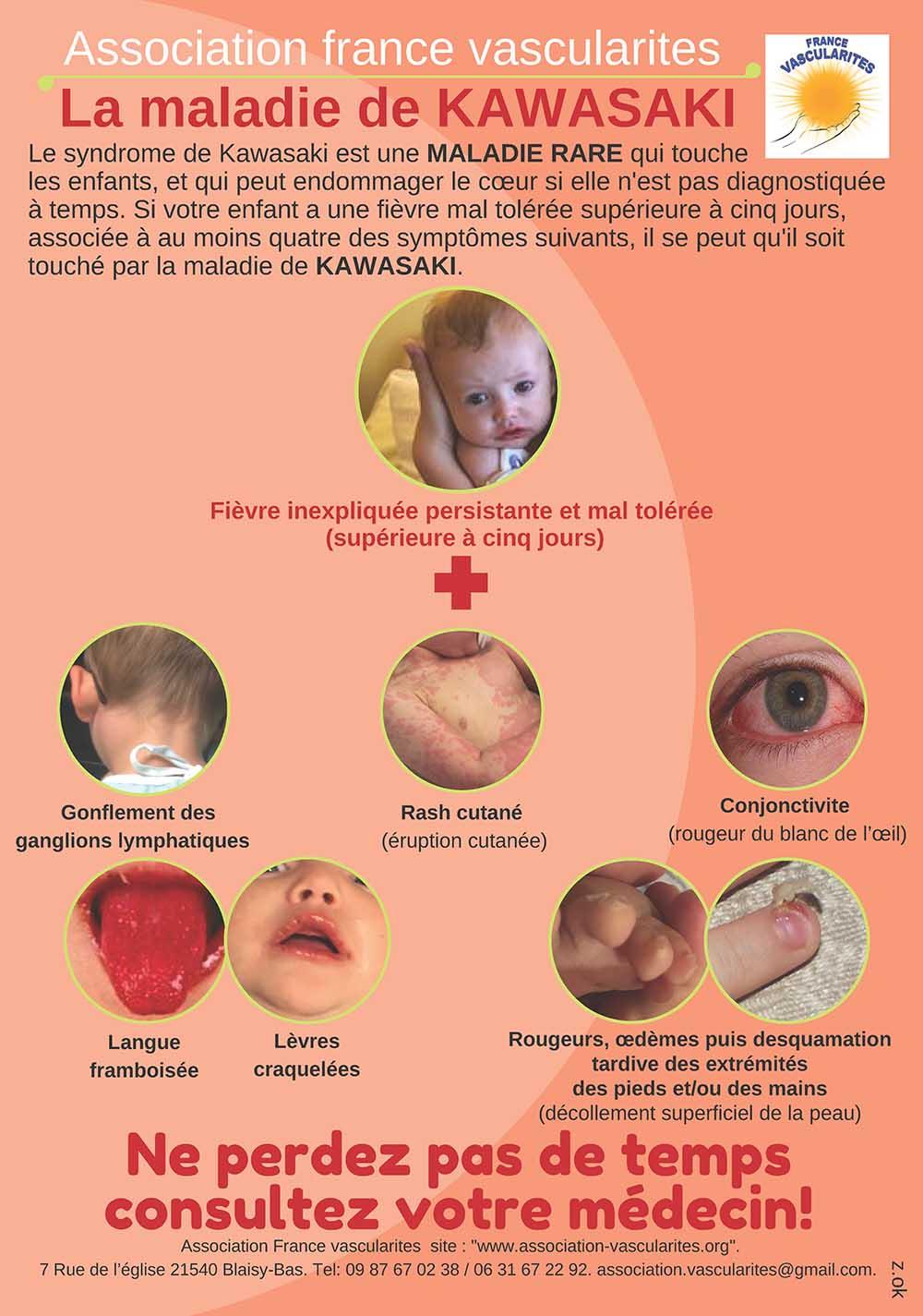 Maladie de Kawasaki et Covid-19 : symptômes, cas en France 