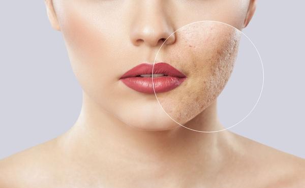 Acne: Are patches really effective to eliminate grains?