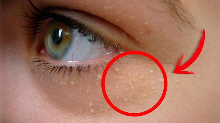 ¿Tienes ‘bolitas blancas’ cerca del ojo? 6 trucos caseros para removerlas