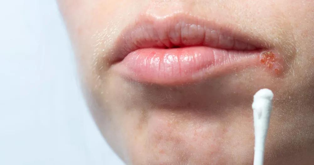 Perlèche (infection des lèvres) : symptômes, causes et traitements 