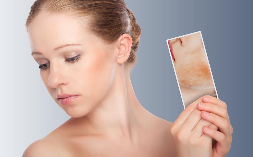 Rosácea: esto es lo que debes saber para limpiar tu piel