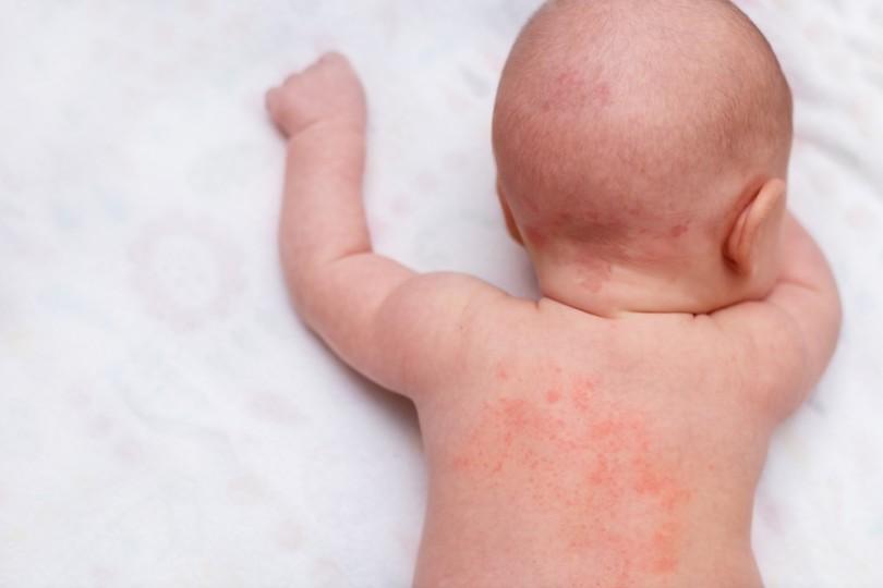 Sweating mainly affects babies and other small patients. How to treat them properly?