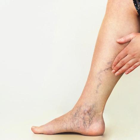Varicose veins: when the veins get tangled
